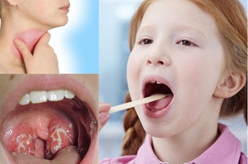 Viêm họng ở trẻ có thể gây biến chứng viêm amidan
